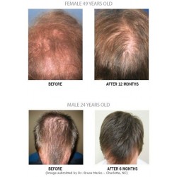 LLLT  Hair Growth  Regrowth  Laser Light Photon EMS RF Massage Comb Brush Device