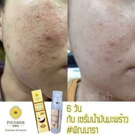 10X PINNARA Coconut Oil Serum Organic100% Vitamin C&E prevent for skin&hair 85ml