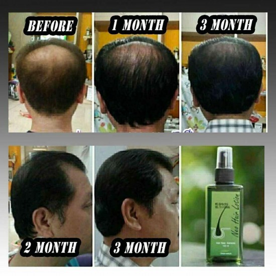 8 x Neo Hair Lotion Growth Root Hair Loss Treatments beards sideburns 120ml