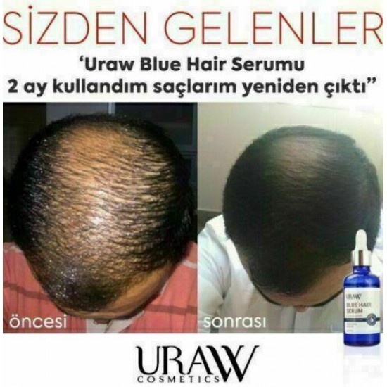 4 x URAW Blue Hair Serum + Dermaroller Set (4+1 Advantage Pack) (NEW DESIGN)