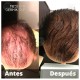 HAIR DERMIK MEDIDERMKI MESOTHERAPY DHT LEVELS GINSENG ARGININE BIOTIN HAIR LOSS