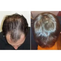 6 PACK MINOXIL Hair Loss Regrowth Spray Hair Loss Men %5 FDA Approved 2 Oz. 2023