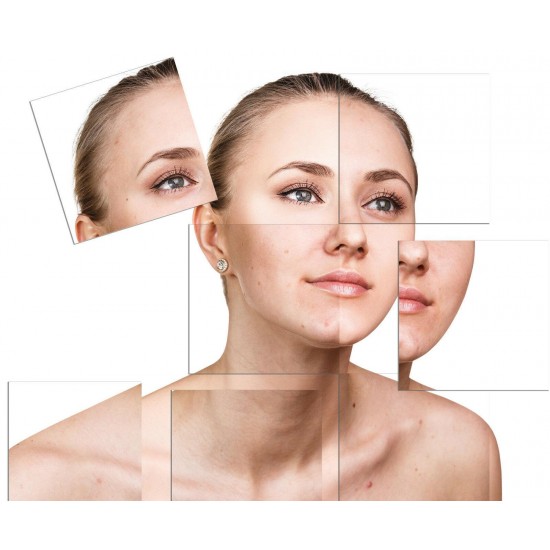 Treat Acne Rosacea Blepharitis | Demodex Treatment for Scalp Skin Face and Body