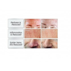 5 x Skinception Rosacea Relief #1 Rapid Remedy Treatment Facial Redness & Pain