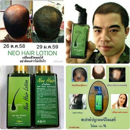 20 Neo Hair Lotion Hair Transplant Beard Brow Sideburns Fall control 120ml +DHL