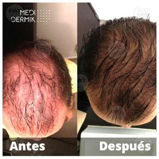 HAIR DERMIK MEDIDERMKI MESOTHERAPY DHT LEVELS GINSENG ARGININE BIOTIN HAIR LOSS