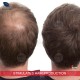 DERMHAIR DERMCLAR MESOTHERAPY HAIR LOSS PANTHENOL TRACE ELEMENTS ALOPECIA