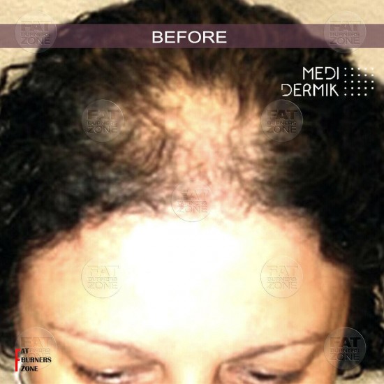 HAIR DERMIK MEDIDERMKI MESOTHERAPY DHT LEVELS GINSENG ARGININE BIOTIN HAIR LOSS