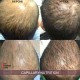 HAIR DERMIK MEDIDERMKI MESOTHERAPY DHT LEVELS GINSENG ARGININE BIOTIN HAIR LOSS