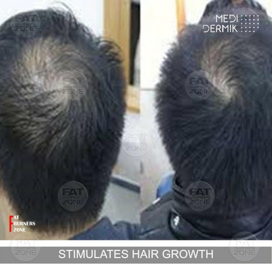 HAIR LOSS MESOTHERAPY TREATMENT HAIR DERMIK GLUTATHIONE ORGANIC SILICIUM