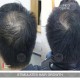 HAIR LOSS MESOTHERAPY TREATMENT HAIR DERMIK GLUTATHIONE ORGANIC SILICIUM