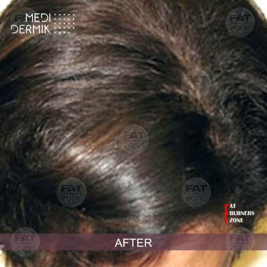 HAIR DERMIK MEDIDERMKI MESOTHERAPY DHT LEVELS GINSENG ARGININE BIOTIN HAIR LOSS