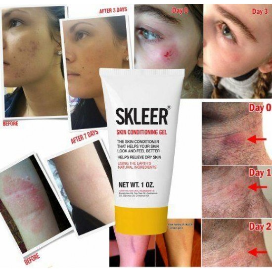 SKLEER - Blackhead & Whitehead removal & prevention of Recurrence