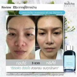 12x Natcha Serum Freckles Natural extracts White Serum Reduce Dark Spot Acne