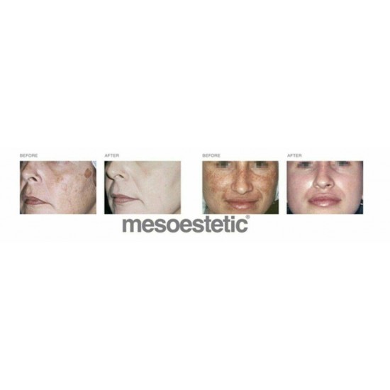 Mesoestetic Cosmelan Treatment Pack New 5 products set Expired 2024