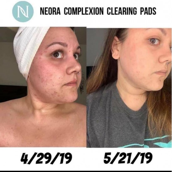 Acne Pads & Cleanser Combo