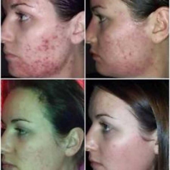 LUMINESCE™ Cleanser & Serum for Blemishes-Pimples-Acne-Potholes-Scars